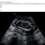Intrauterine Fetal Death (IUFD) — Diagnosis & High-Yield Points