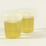 What is a Urine Test? Urine Routine and Microscopy Explained