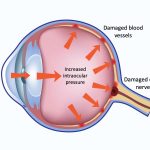 Short Notes on Intraocular Pressure IOP (update 2025)