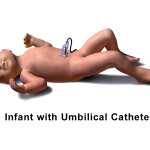 Umbilical Vein Catheterization (UVC) Notes