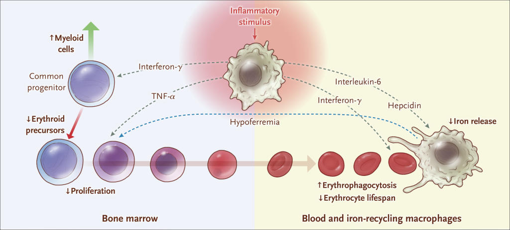 anemia secpndary to inflammation pathophysiology