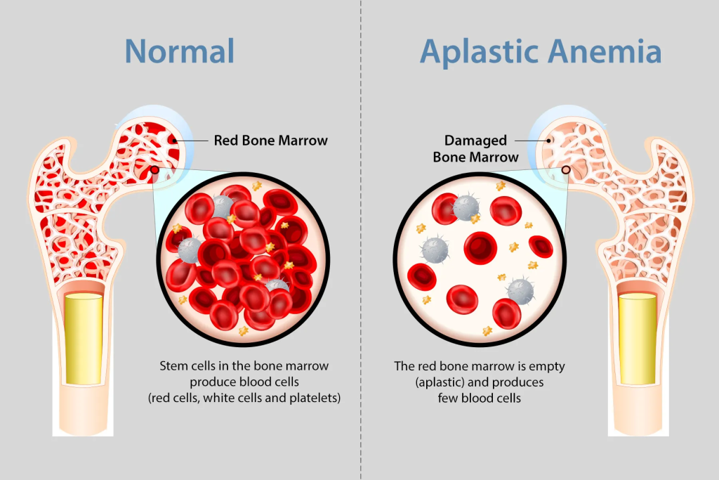 aplastic anemia 
