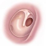 Here is Treatment: Perforated Acute Otitis Media (AOM with tympanic membrane perforation)