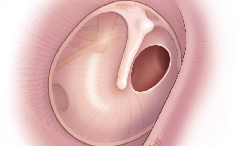 perforated Tympanic membrane