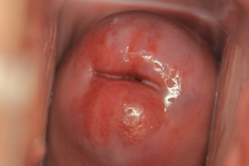 cervical ectropion