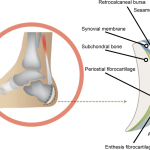What is enesthitis and how is it treated?