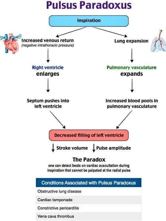 pulsus paradoxus pathophysiology