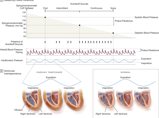 measurement of pulsus paradoxus
