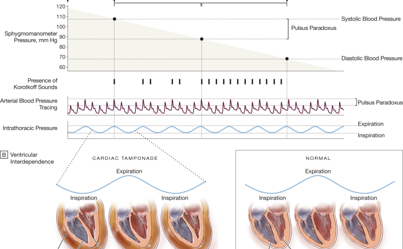 measurement of pulsus paradoxus