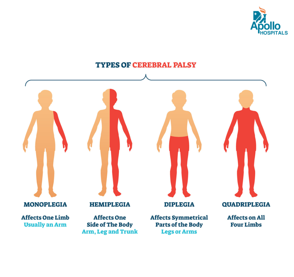 types of cerebral palsy