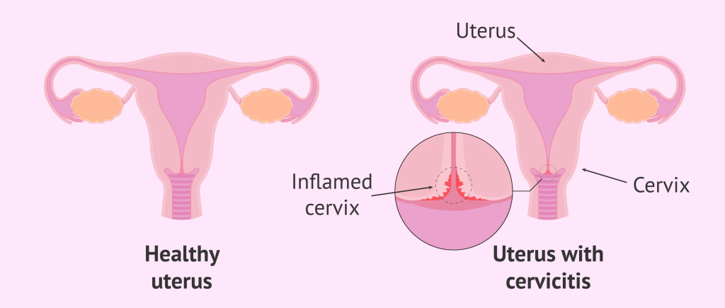 health cervix vs cervicitis