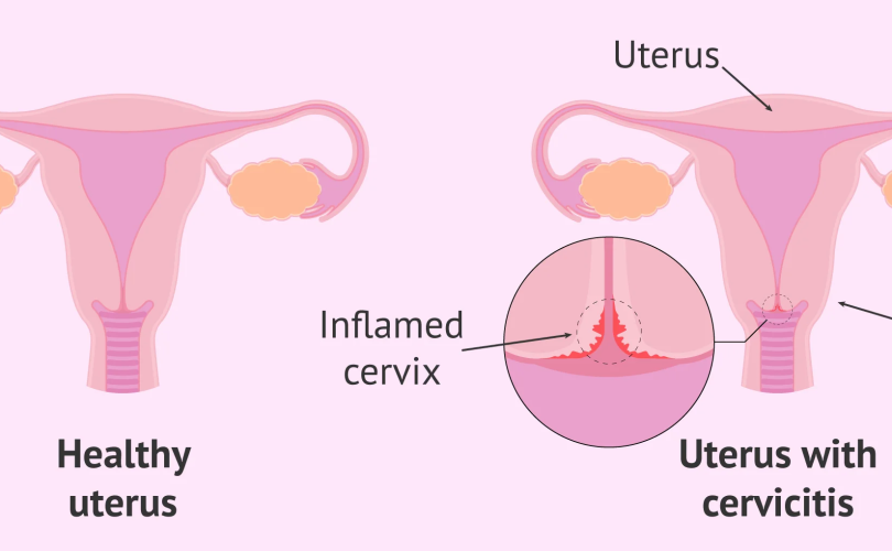 what is cervicitis