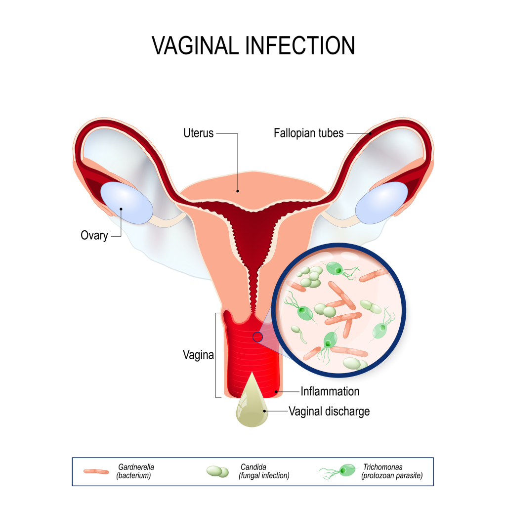 what is vaginal infection