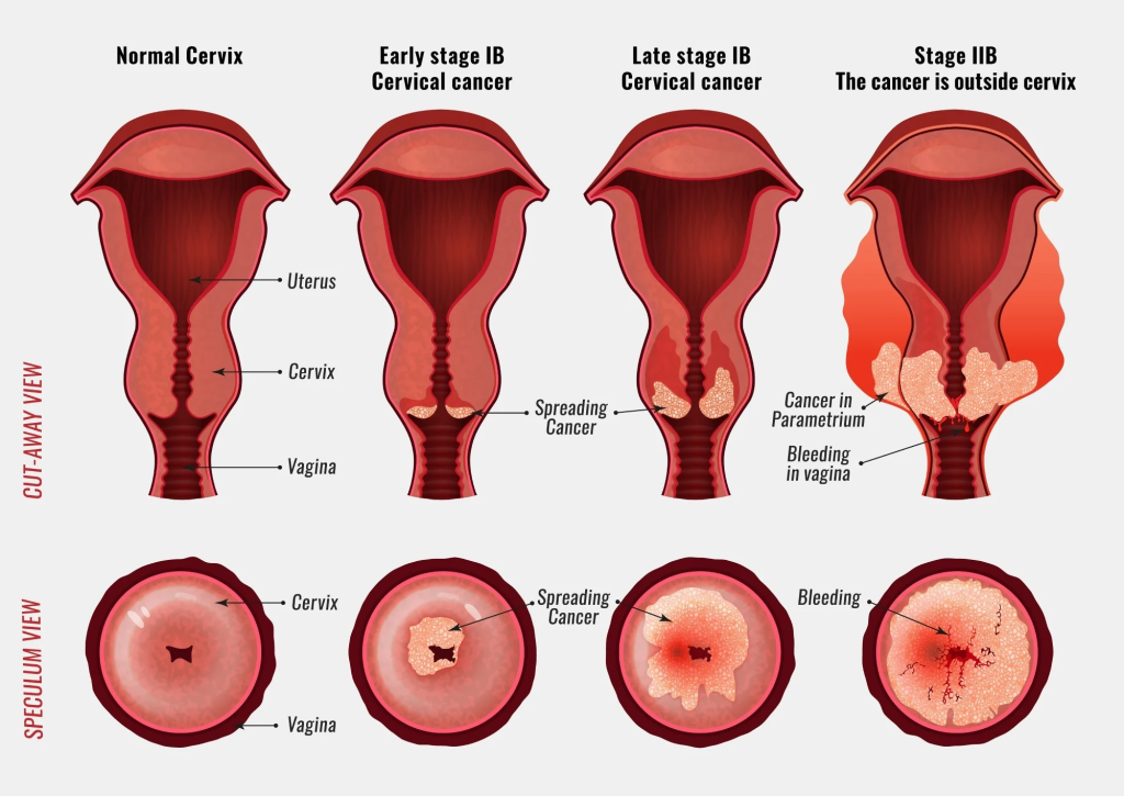 stages of cervical cancer