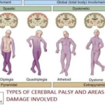 Cerebral Palsy: Complete Clinical Guide (Causes, Types, Diagnosis and Management)