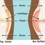 JIA, Classifications, Type and Diagnostic Criteria