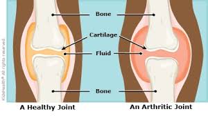JIA juvenile idiopathic arthritis