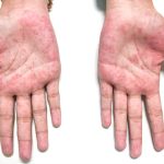 kawasaki disease