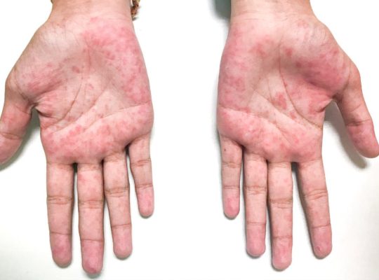 kawasaki disease
