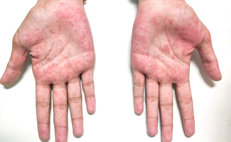 kawasaki disease
