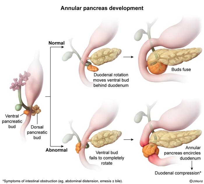 annula pancrese image