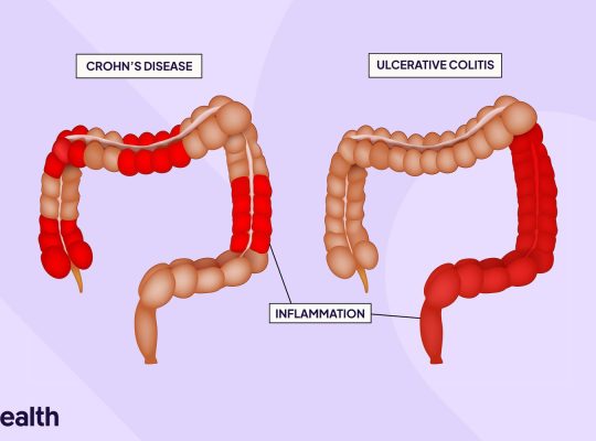 ulcerative colitis vs chrons disease