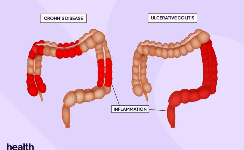 ulcerative colitis vs chrons disease
