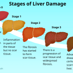 Complete Definition of Acute Liver Failure (According to Nelson)