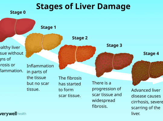stages of liver failure