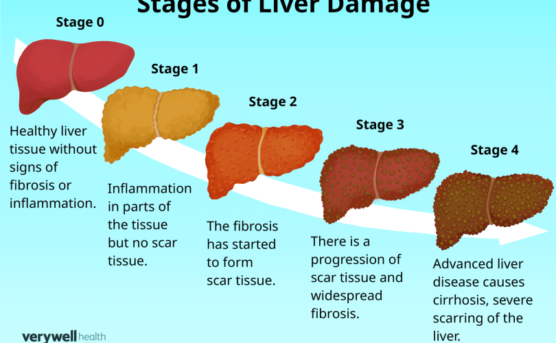 stages of liver failure