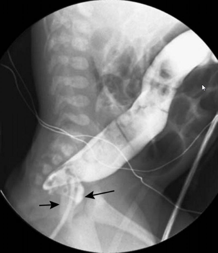 hirschprungs disease in down syndrome