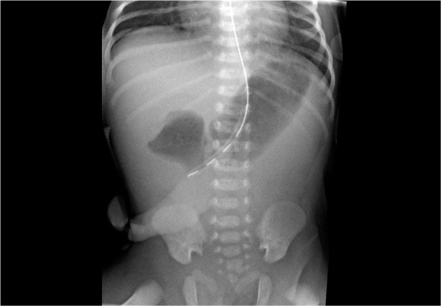 x ray abdomen in down syndrome