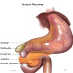 5 Very Important Abdominal (GI) anomalies in Down syndrome
