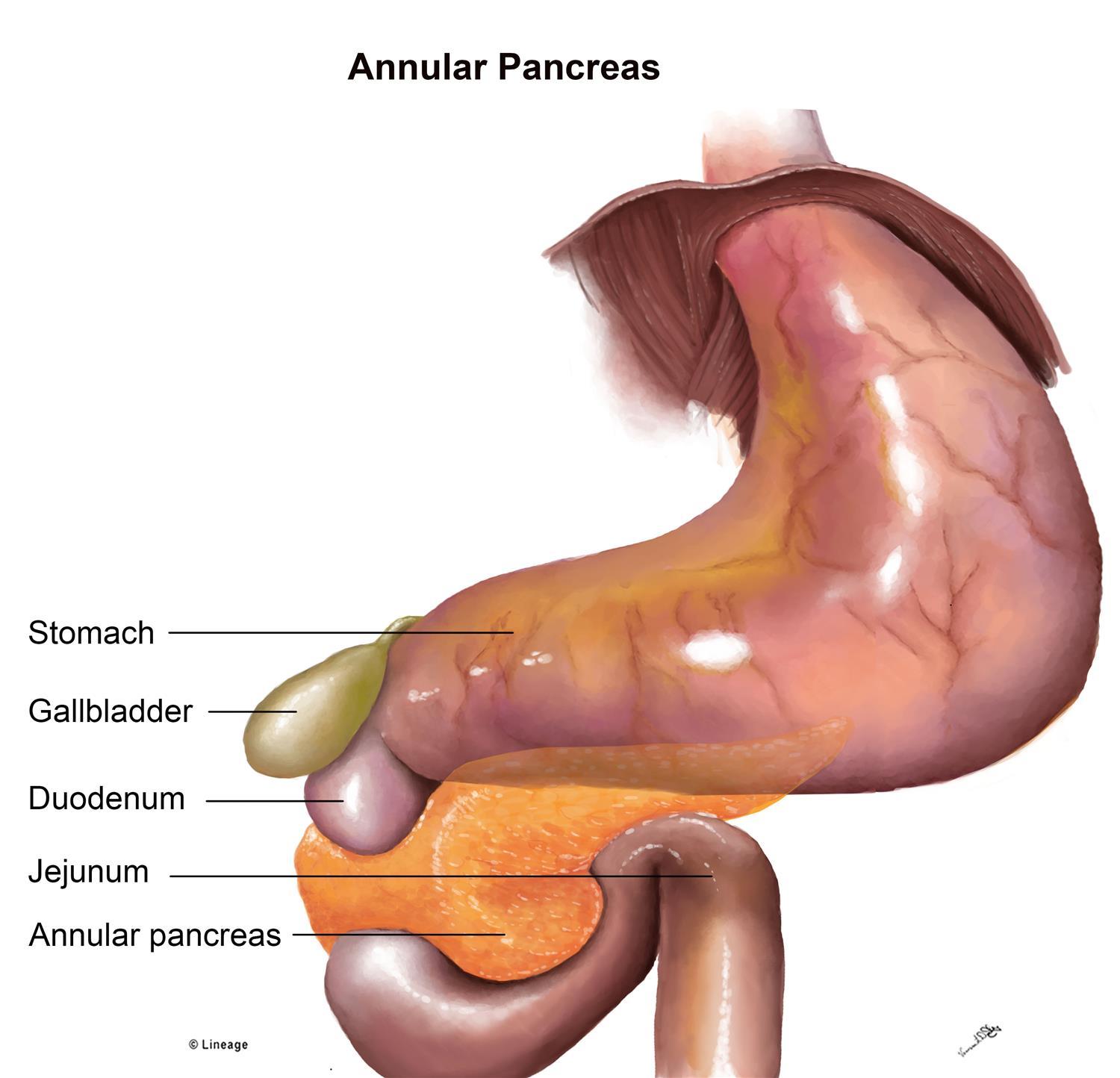 5 Very Important Abdominal GI Anomalies In Down Syndrome Dr 5 Very Important Abdominal GI Anomalies In Down Syndrome Dr