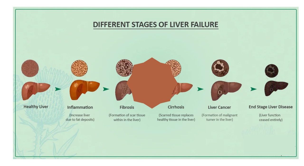 acute liver failure