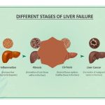 Acute Hepatic Failure in Children (Pediatric Acute Liver Failure): Complete Clinical Guide