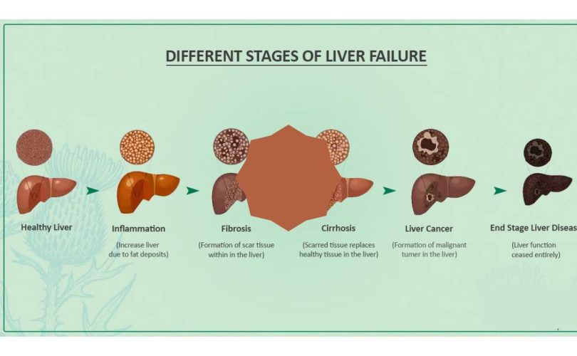 acute liver failure