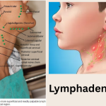 Significant lymph node enlargement: Definition, Meaning and Interpretation (MD Level)