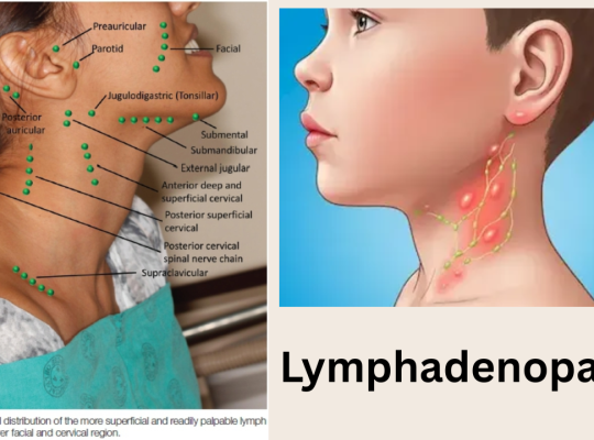 lymphadenopathy cause