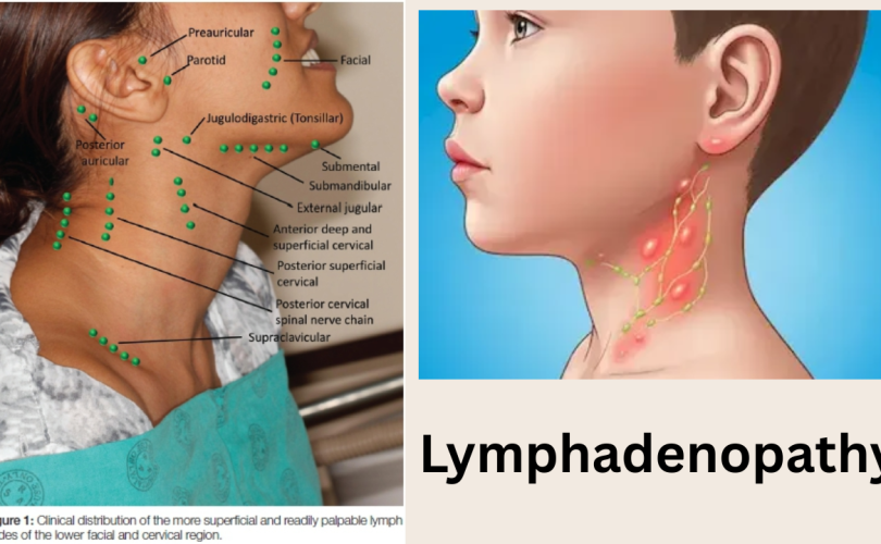 lymphadenopathy cause