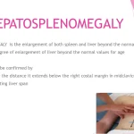 Are you stuck with Diagnosis? Here is prolonged fever + hepatosplenomegaly + persistent leukocytosis diagnoses summarized!