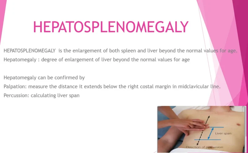 hepatosplenomegaly