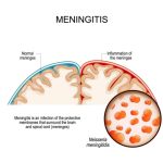Bacterial meningitis in older children: Antibiotic choice and duration